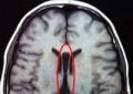 Хирургическое лечение эпилепсии, вызванной дисгенезиями коры головного мозга